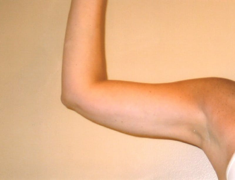 Liposuction Before & After Gallery - Patient 252425 - Image 2