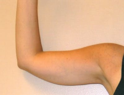 Liposuction Before & After Gallery - Patient 252425 - Image 1