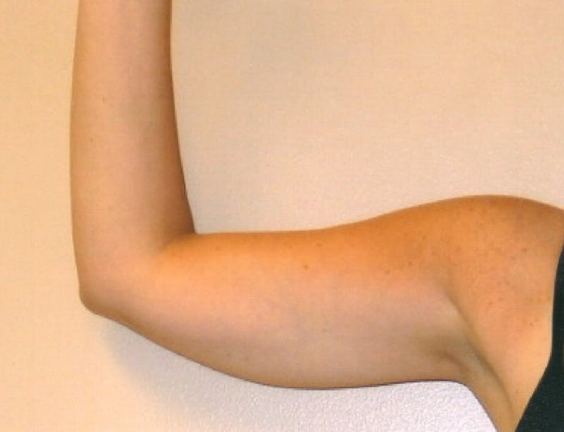 Liposuction Before & After Gallery - Patient 252425 - Image 1