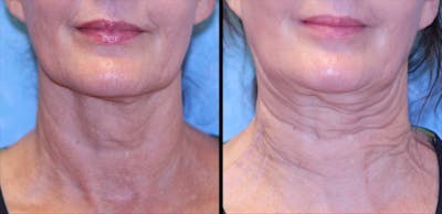 Sofwave Before & After Gallery - Patient 114650 - Image 1