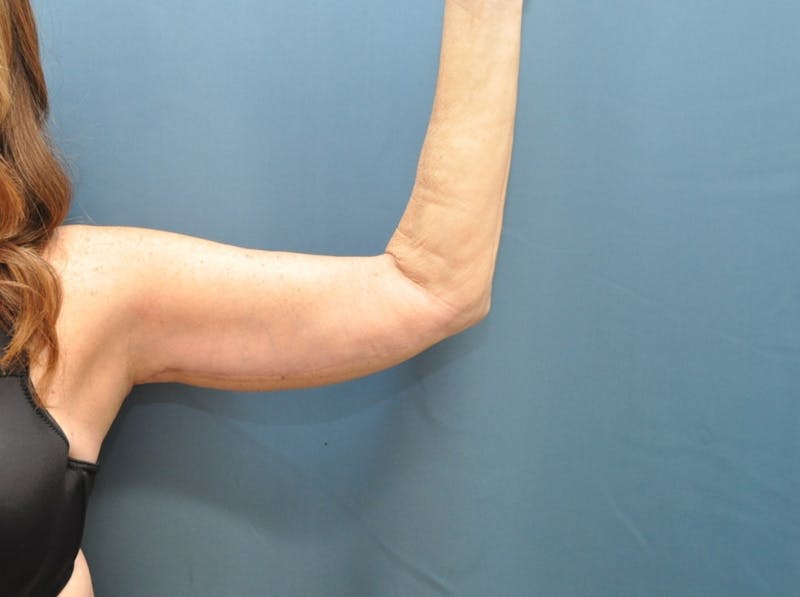 Arm Lift Before & After Gallery - Patient 235965 - Image 2