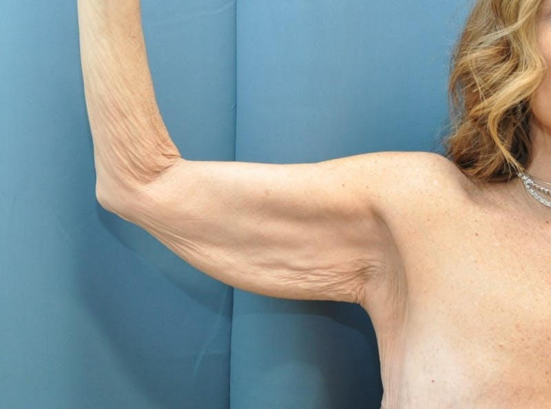 Arm Lift Before & After Gallery - Patient 235965 - Image 3