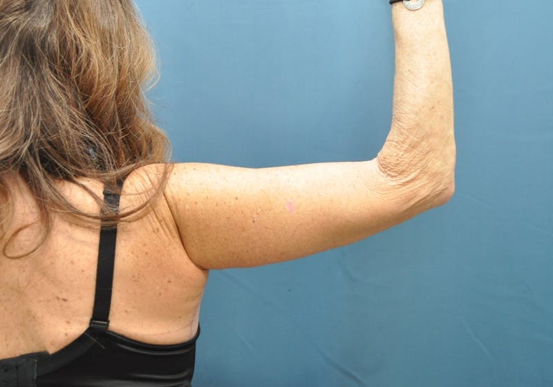 Arm Lift Before & After Gallery - Patient 235965 - Image 6