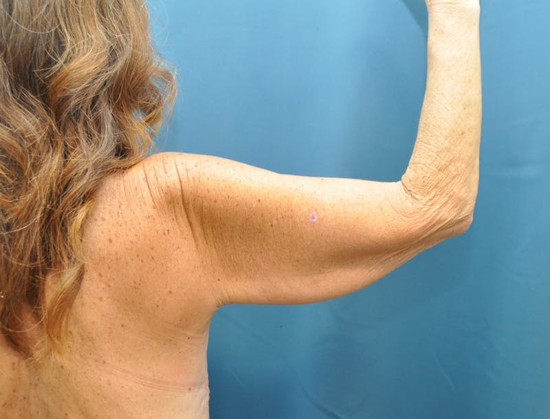 Arm Lift Before & After Gallery - Patient 235965 - Image 5