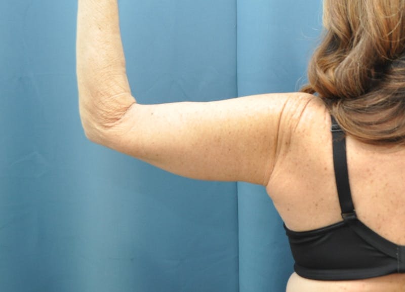 Arm Lift Before & After Gallery - Patient 235965 - Image 8