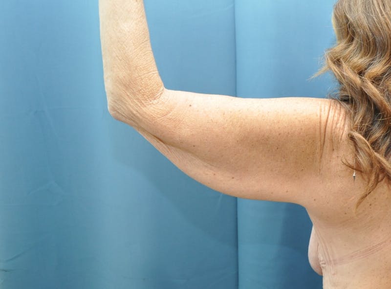 Arm Lift Before & After Gallery - Patient 235965 - Image 7