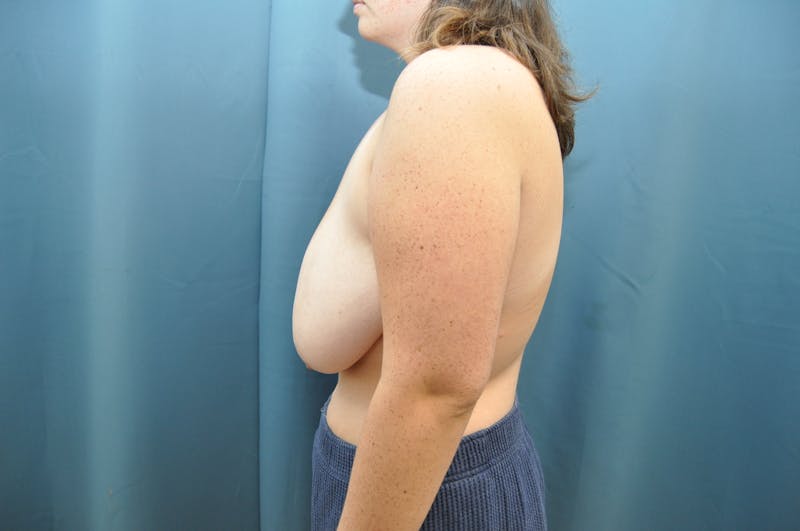 Breast Reduction Before & After Gallery - Patient 593481 - Image 5