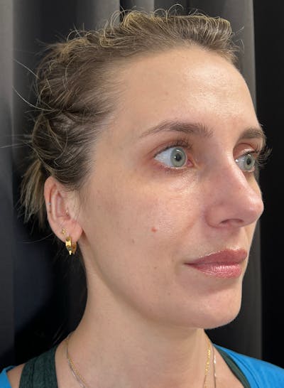 BBL/Moxi Before & After Gallery - Patient 133207 - Image 2