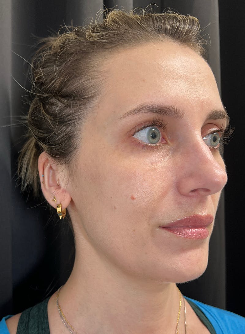 BBL/Moxi Before & After Gallery - Patient 133207 - Image 2