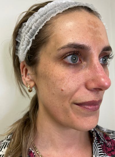 BBL/Moxi Before & After Gallery - Patient 133207 - Image 1