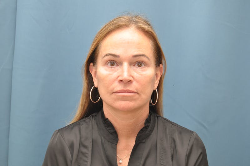 Facelift Before & After Gallery - Patient 407475 - Image 2