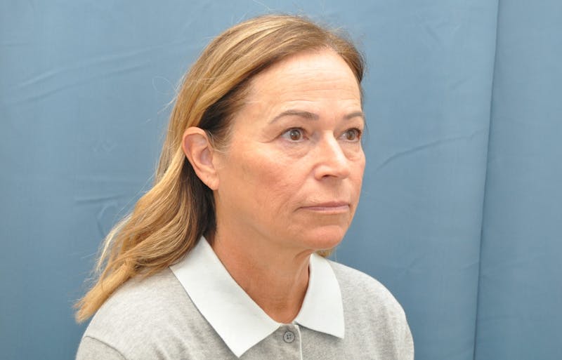 Facelift Before & After Gallery - Patient 407475 - Image 3