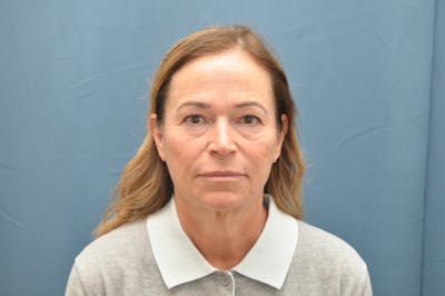 Facelift Before & After Gallery - Patient 407475 - Image 1