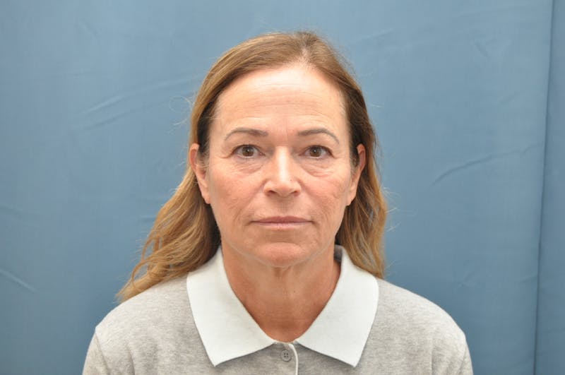 Facelift Before & After Gallery - Patient 407475 - Image 1