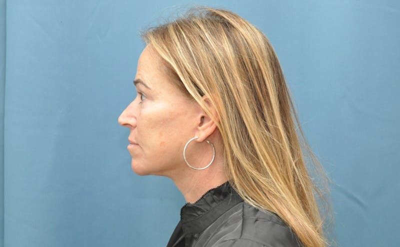 Facelift Before & After Gallery - Patient 407475 - Image 6