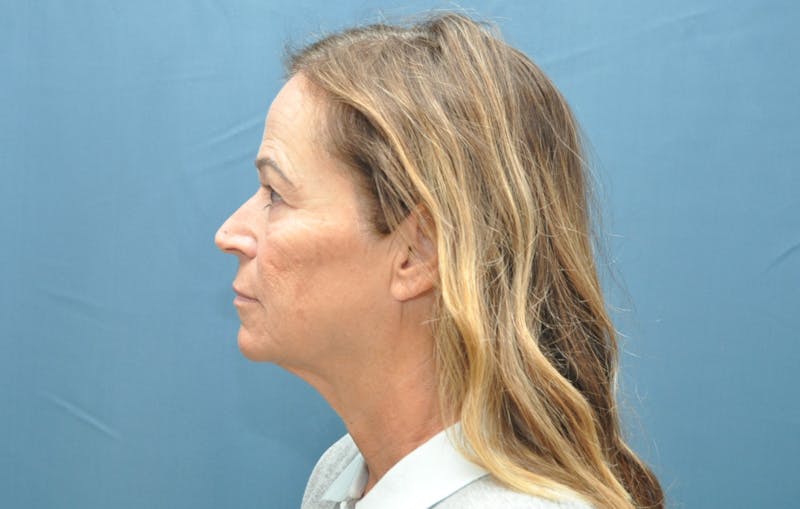 Facelift Before & After Gallery - Patient 407475 - Image 5