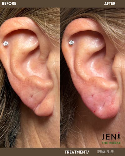 Dermal Fillers Before & After Gallery - Patient 258469 - Image 1