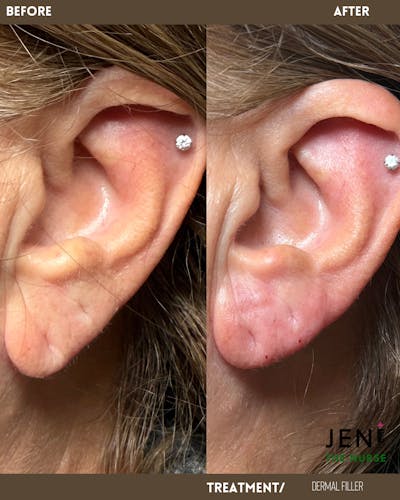 Dermal Fillers Before & After Gallery - Patient 258469 - Image 2