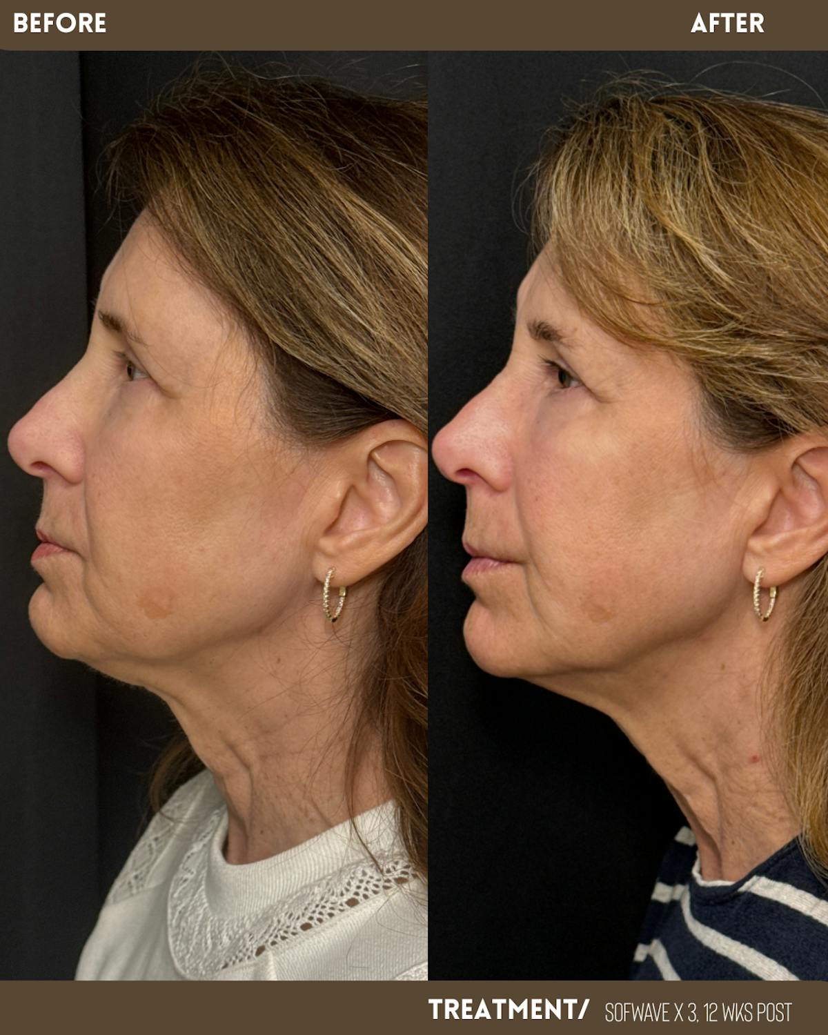 Sofwave Before & After Gallery - Patient 350463 - Image 1