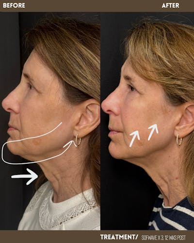 Sofwave Before & After Gallery - Patient 350463 - Image 2