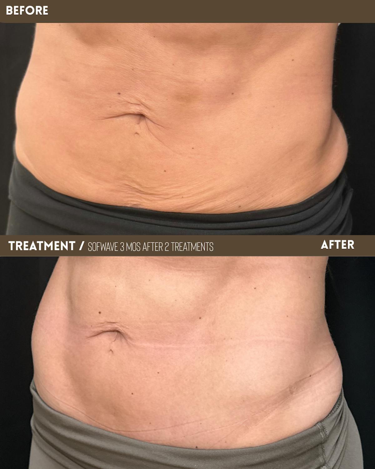 Sofwave Before & After Gallery - Patient 371282 - Image 2