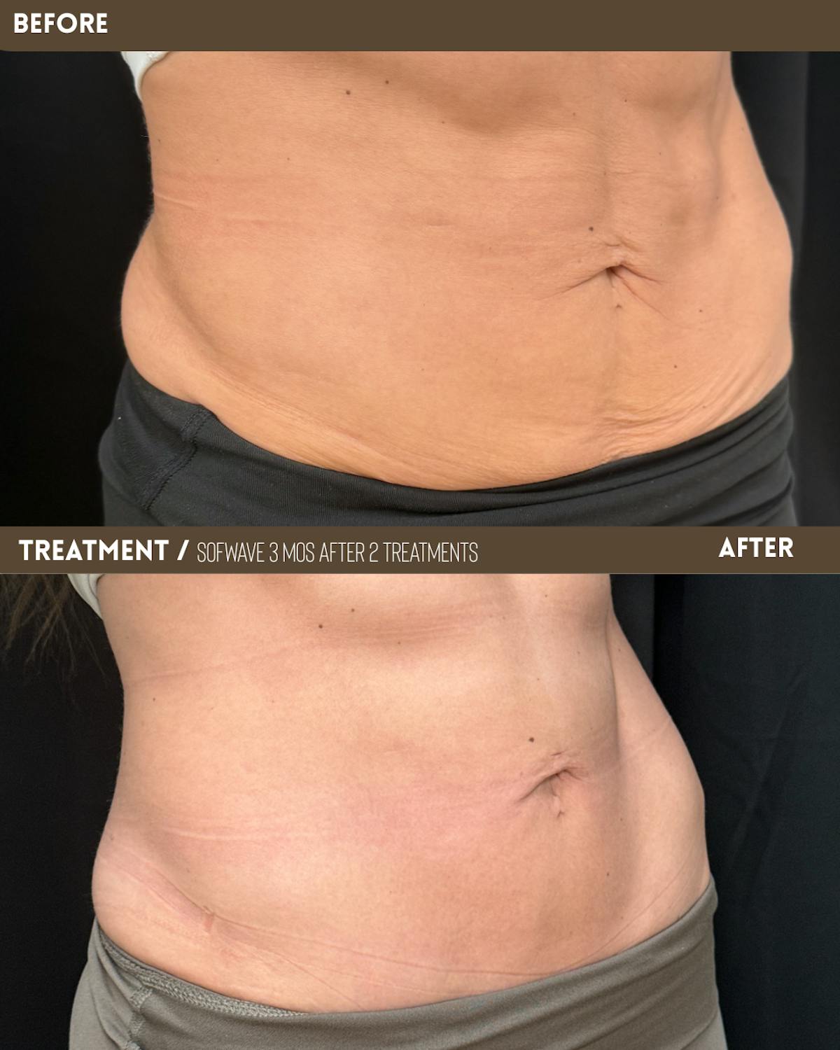 Sofwave Before & After Gallery - Patient 371282 - Image 3