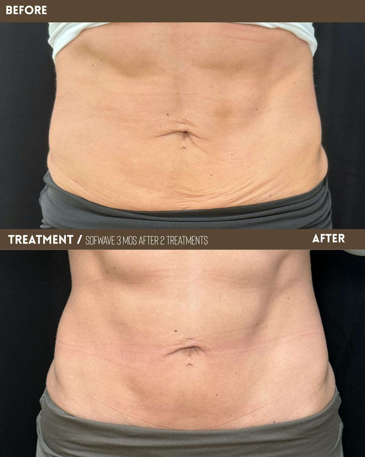 Sofwave Before & After Gallery - Patient 371282 - Image 1