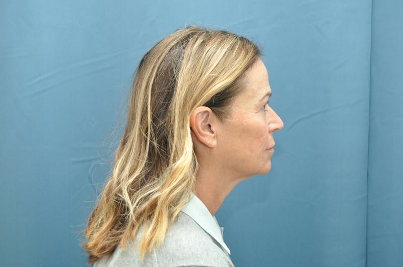 Facelift Before & After Gallery - Patient 474062 - Image 7