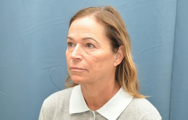 Facelift Before & After Gallery - Patient 474062 - Image 5