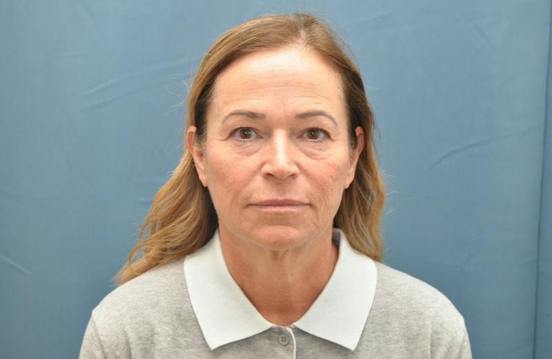 Facelift Before & After Gallery - Patient 474062 - Image 1