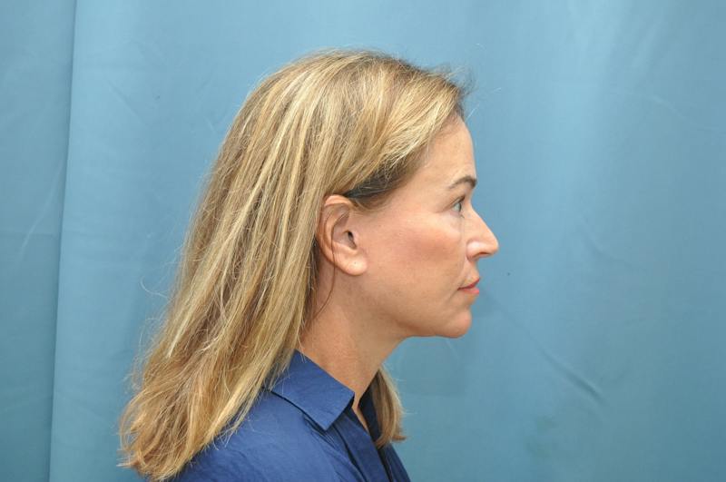 Facelift Before & After Gallery - Patient 474062 - Image 8