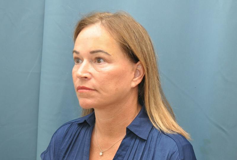 Facelift Before & After Gallery - Patient 474062 - Image 6