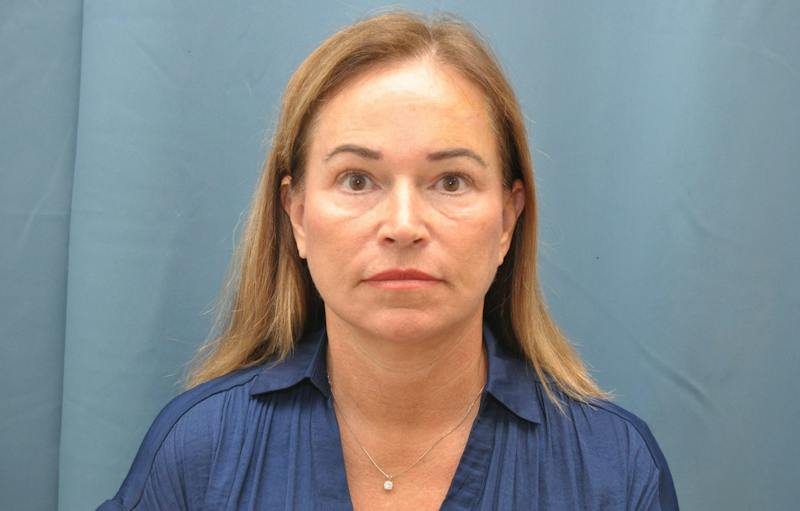 Facelift Before & After Gallery - Patient 474062 - Image 2