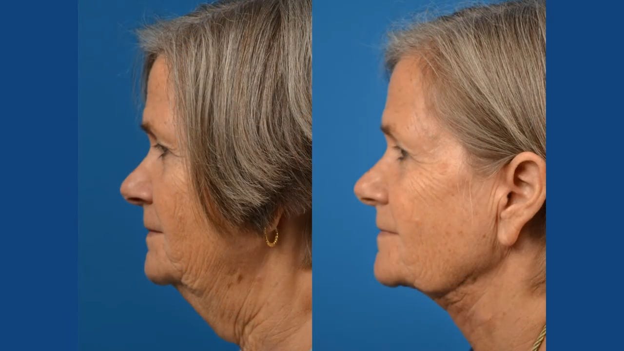 Before and after neck lift surgery at Clevens Face and Body Specialists in Orlando, FL