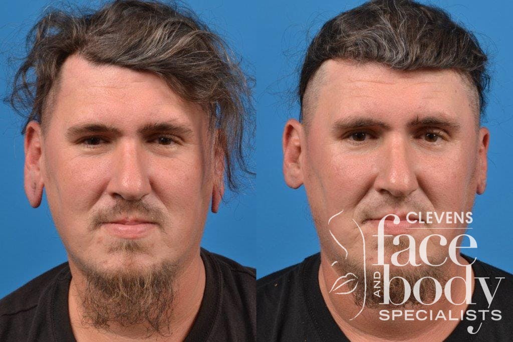 Earlobe Repair