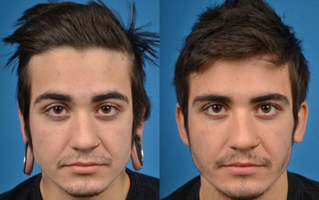 Earlobe Repair