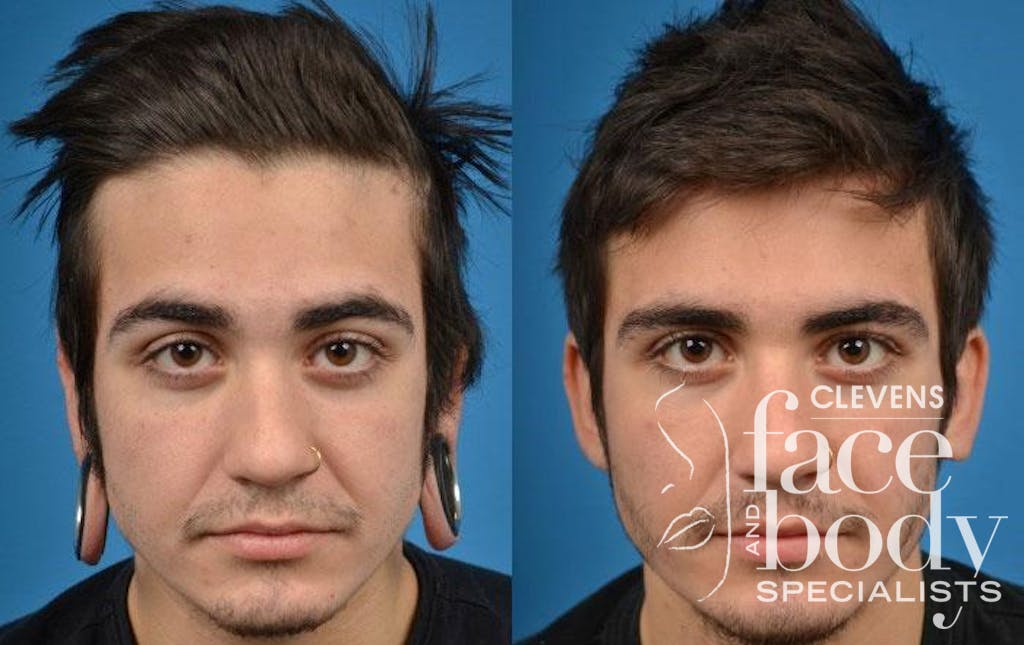 Earlobe Repair