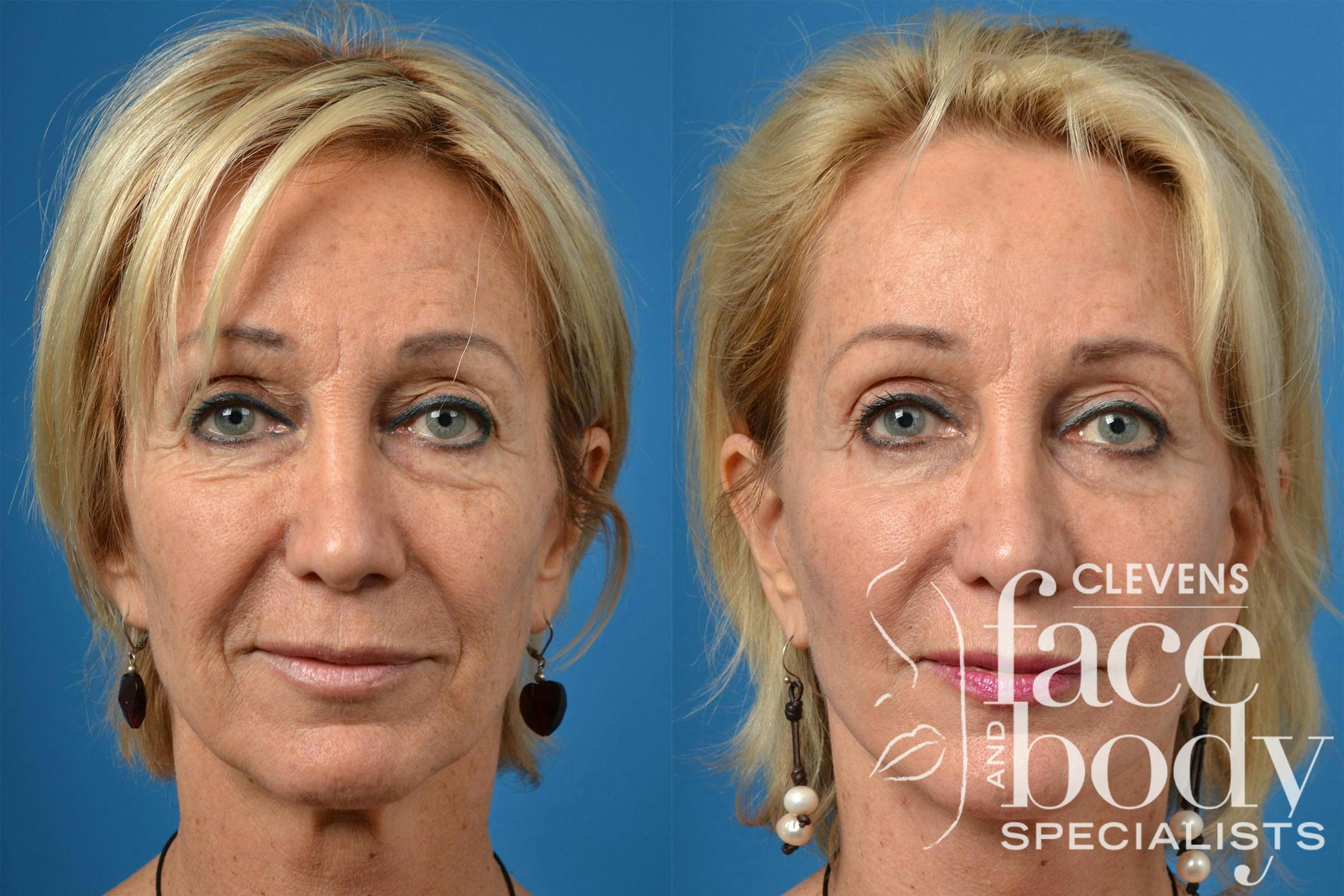 Dermal Fillers