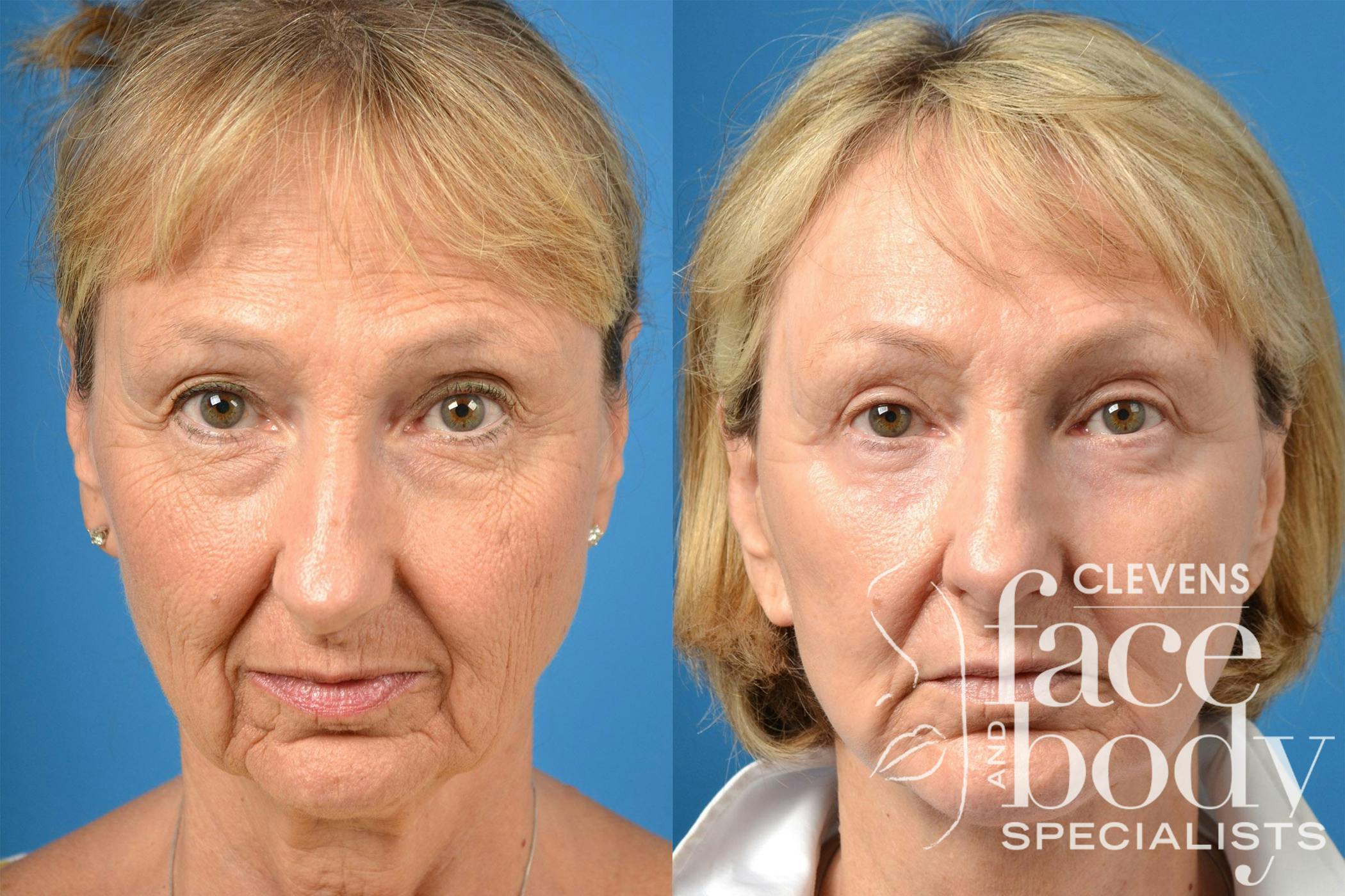 Dermal Fillers