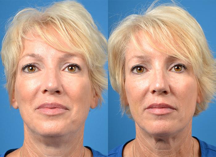 Kybella Procedure