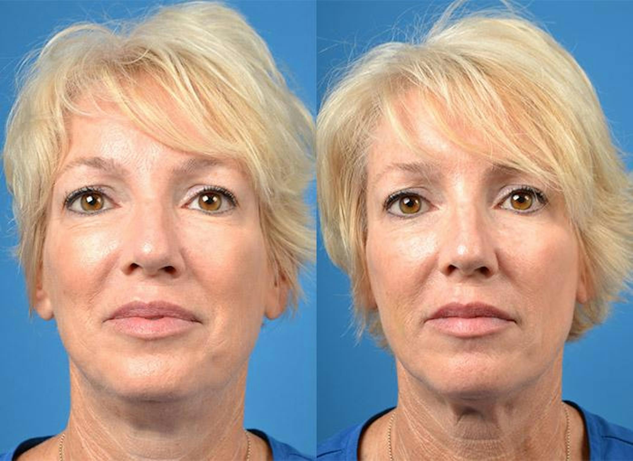 Kybella Procedure