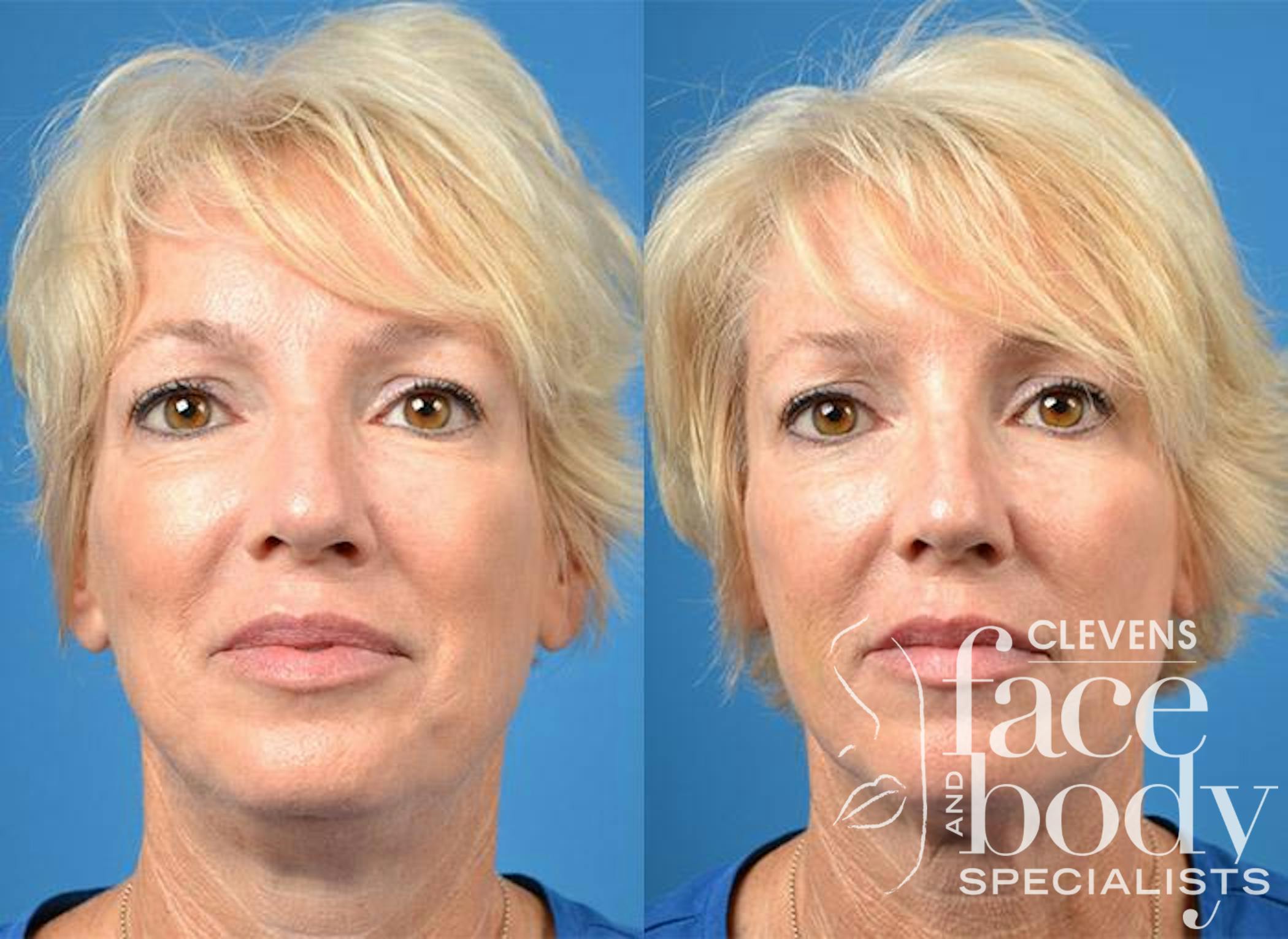 Kybella Procedure