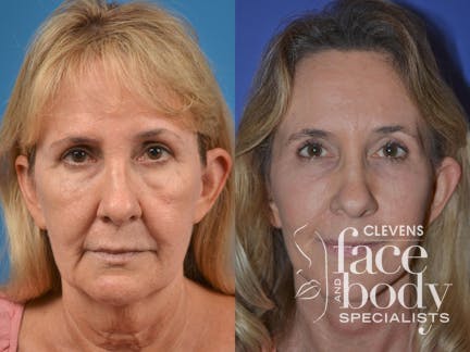 Boletero Procedure