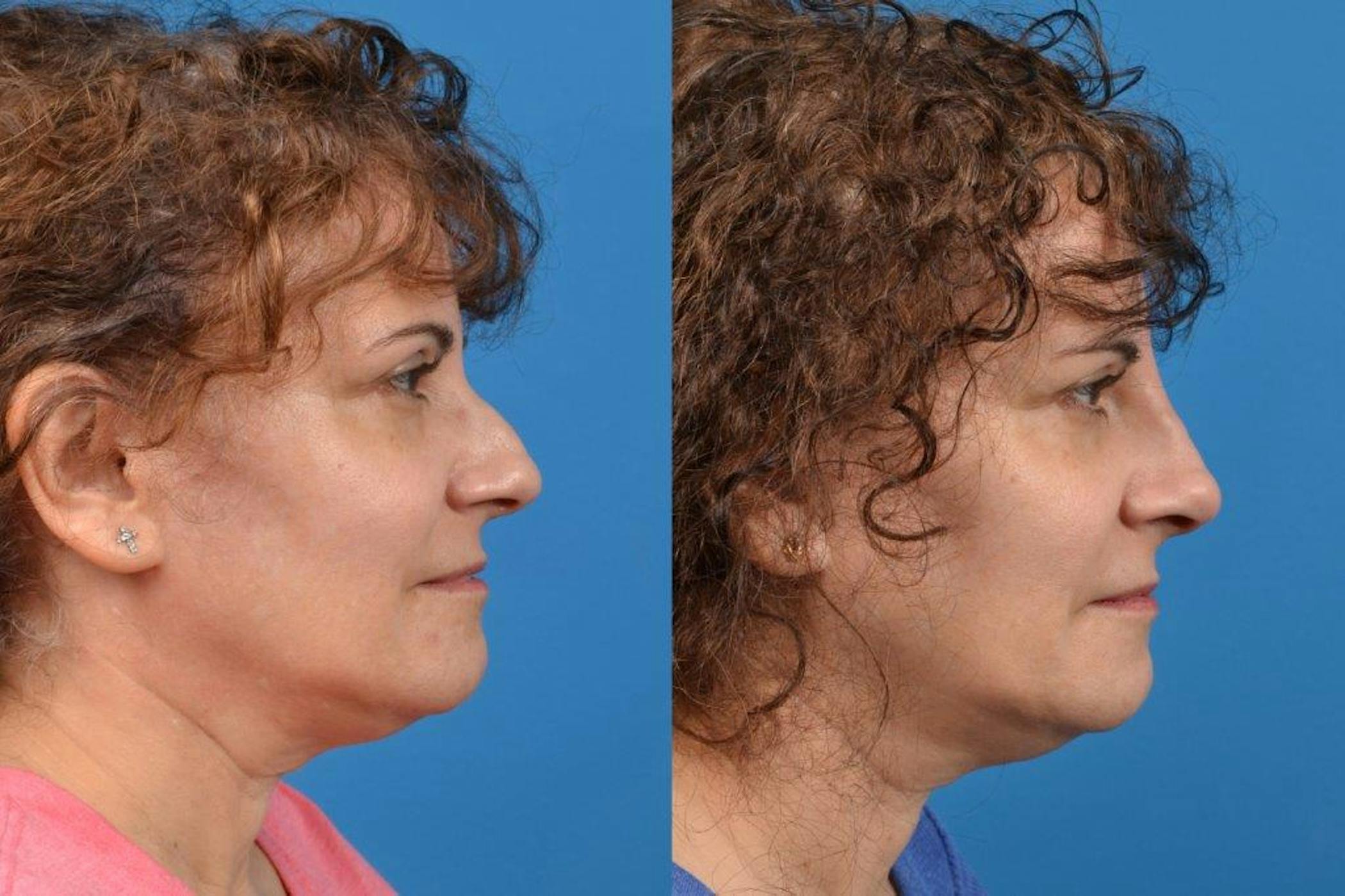 Rhinoplasty Procedure