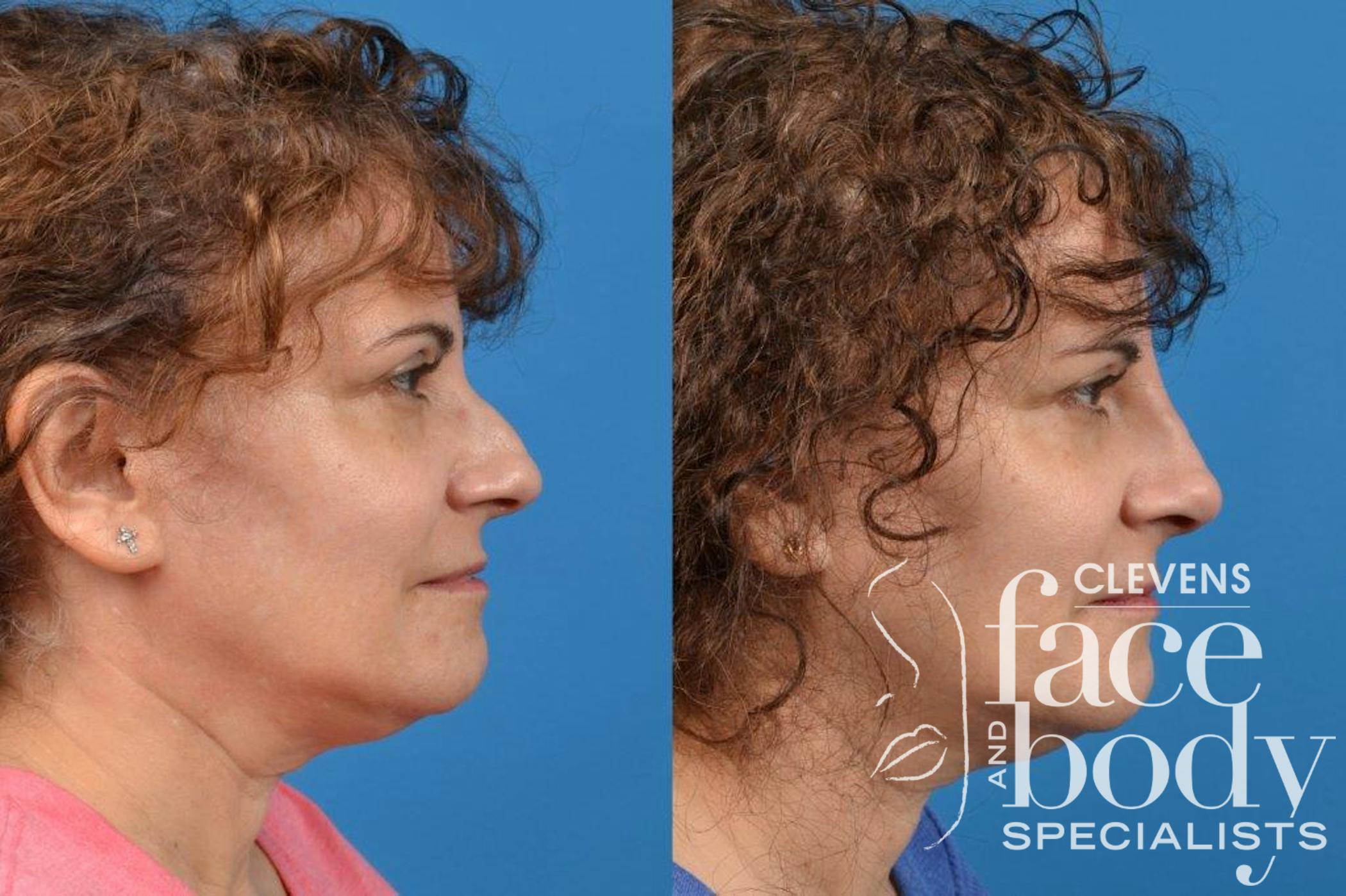 Rhinoplasty Procedure