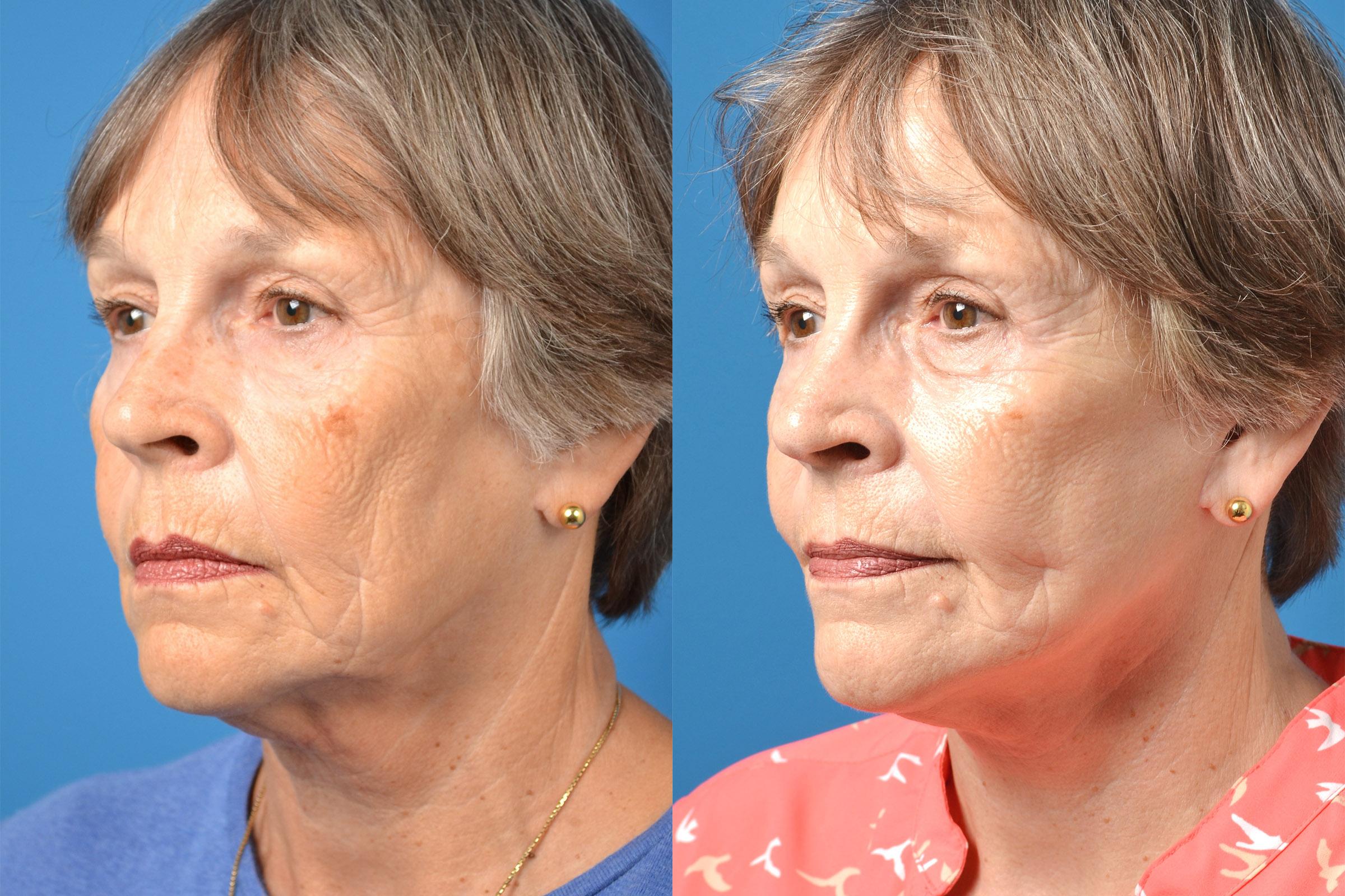 Before and after Sculptra in Melbourne FL
