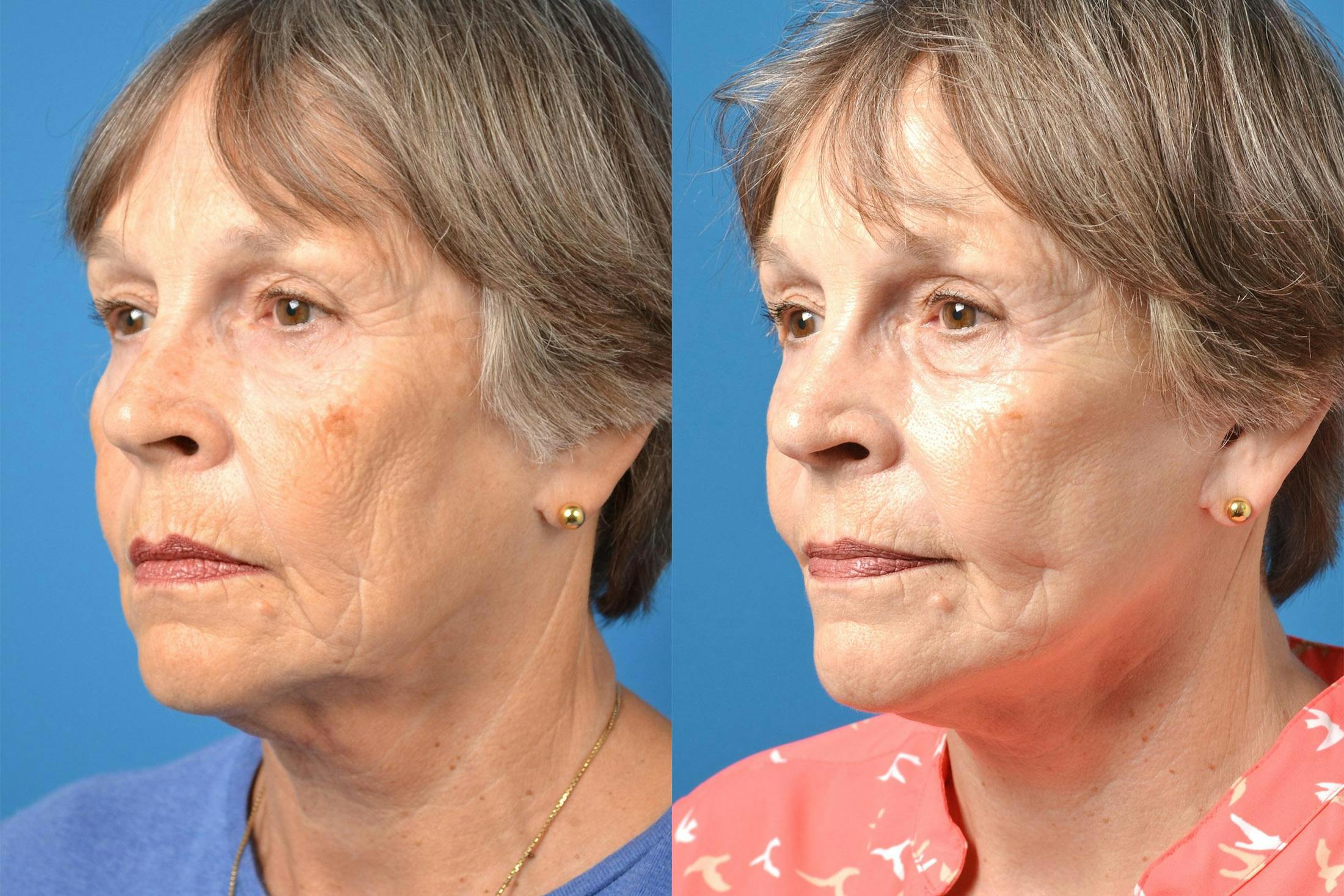 Before and after Sculptra in Melbourne FL