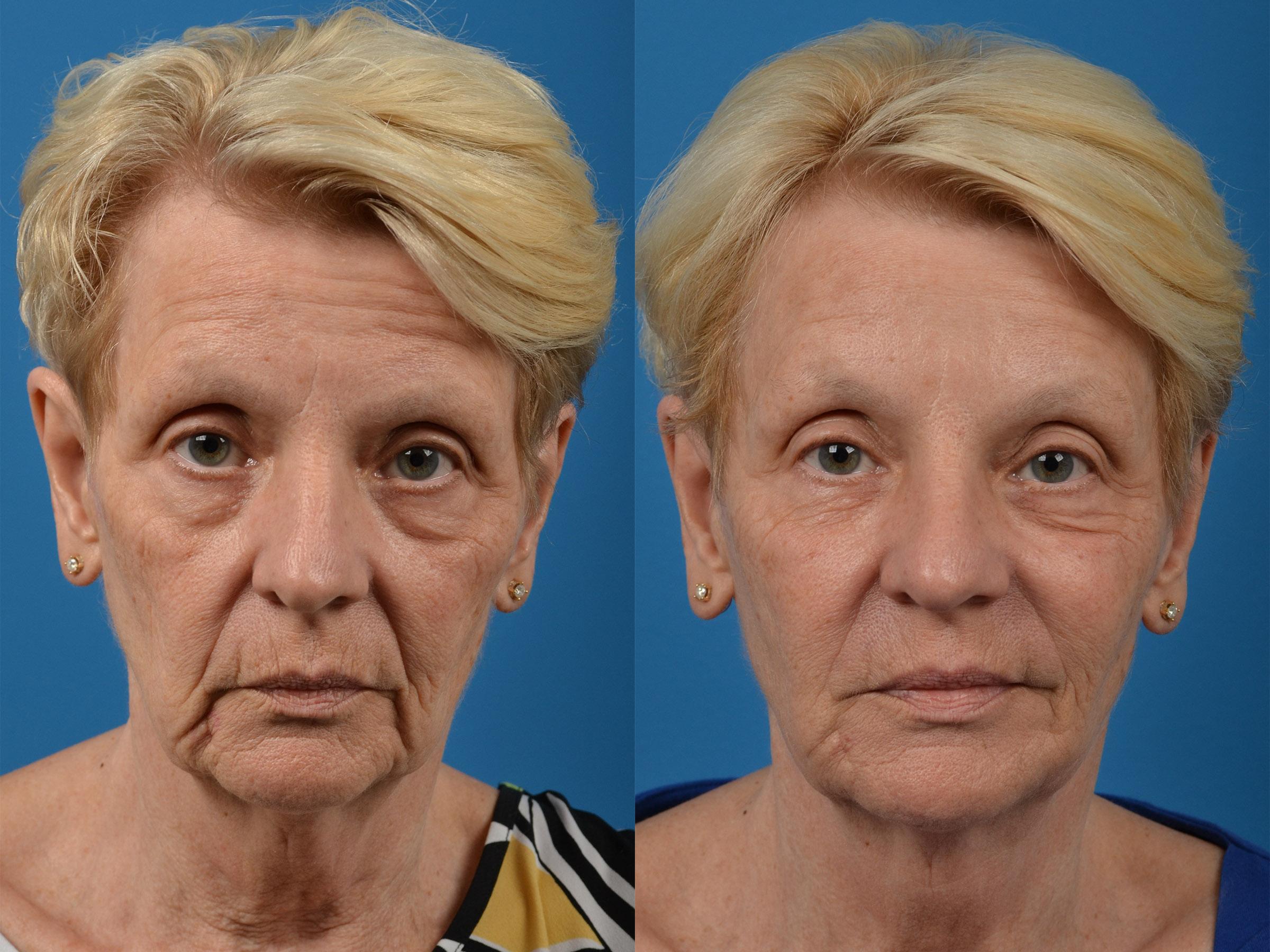 Before & After Sculptra in Merritt Island