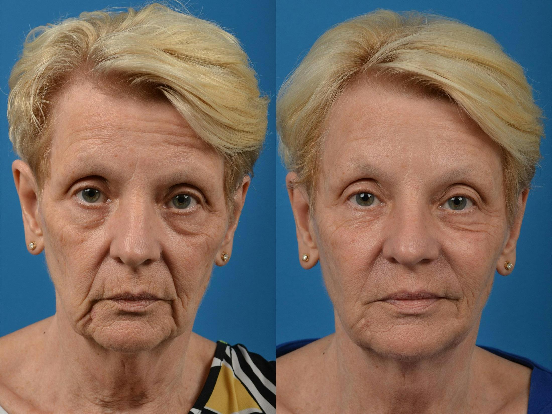 Before & After Sculptra in Merritt Island