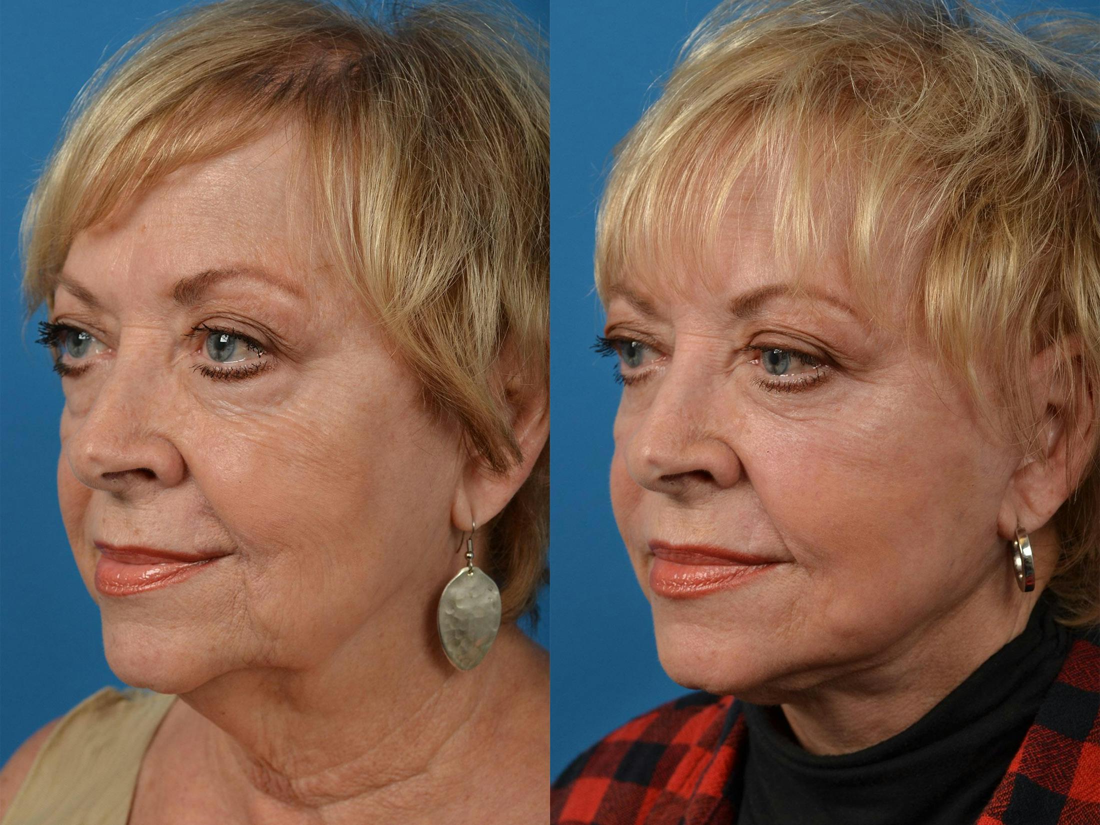 Sculptra results in Merritt Island at Clevens Face and Body Specialists